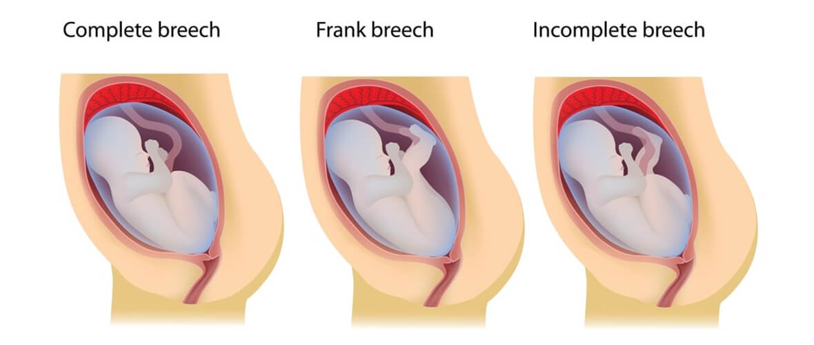 Fetal Position Presentation Guide To Expecting Mothers