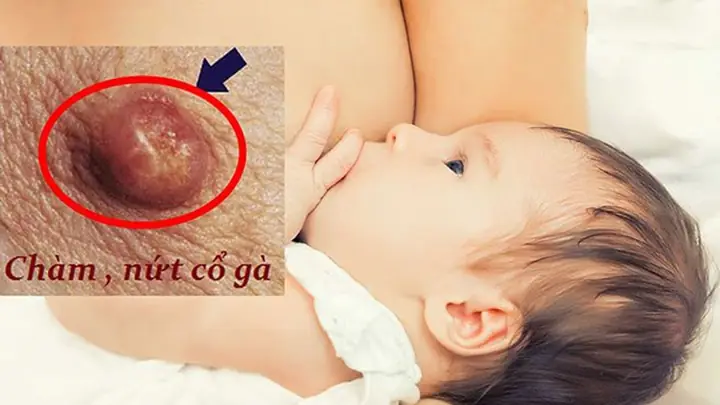 Bị Nứt Cổ Gà Khi Cho Bé Bú Có Nên Tiếp Tục Không? Cách Xử Lý An Toàn & Hiệu Quả