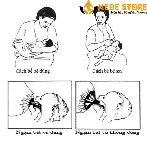 Bị Nứt Cổ Gà Khi Cho Bé Bú Có Nên Tiếp Tục Không? Cách Xử Lý An Toàn & Hiệu Quả