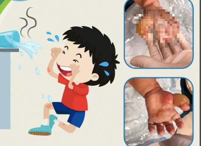 Cách Chữa Bỏng Cho Bé: Sơ Cứu An Toàn, Chăm Sóc Hiệu Quả Tại Nhà