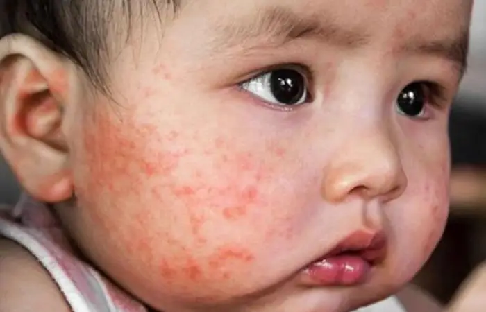 Hướng Dẫn Cách Chữa Chàm Sữa Cho Bé Sơ Sinh An Toàn & Hiệu Quả Tại Nhà