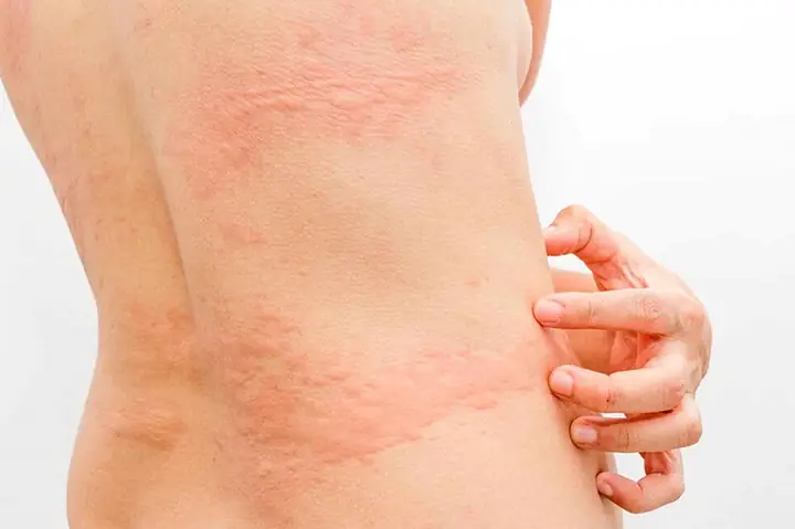 Cách Chữa Dị Ứng Thời Tiết Cho Bé An Toàn, Hiệu Quả Tại Nhà