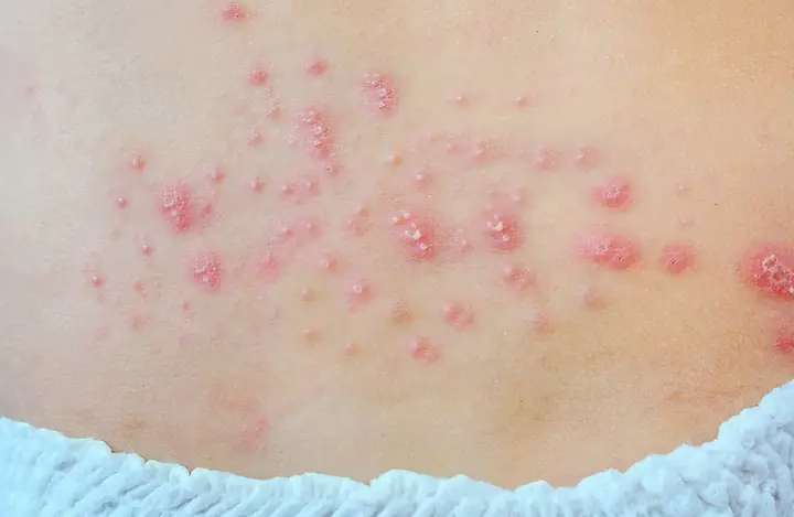 Bé Bị Hăm Cổ: Nguyên Nhân, Dấu Hiệu Và Cách Điều Trị Hiệu Quả Tại Nhà