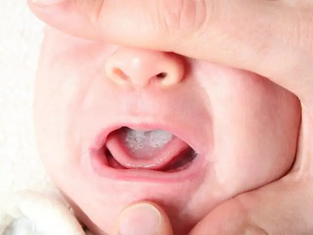 Cách Chữa Lưỡi Trắng Cho Bé An Toàn & Hiệu Quả Theo Y Khoa & Dân Gian Cách Chữa Lưỡi Trắng Cho Bé An Toàn & Hiệu Quả Theo Y Khoa & Dân Gian
