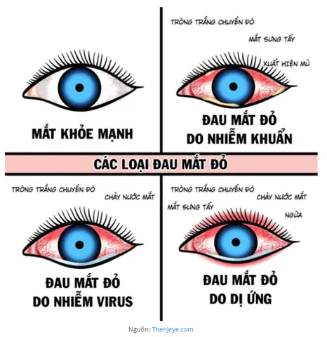 Hướng Dẫn Cách Chữa Mắt Đỏ Cho Bé Hiệu Quả Và An Toàn Tại Nhà Hướng Dẫn Cách Chữa Mắt Đỏ Cho Bé Hiệu Quả Và An Toàn Tại Nhà