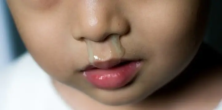 Bé Bị Sổ Mũi Xanh Đặc: Nguyên Nhân, Cách Chữa Trị Tại Nhà & Khi Nào Cần Gặp Bác Sĩ Bé Bị Sổ Mũi Xanh Đặc: Nguyên Nhân, Cách Chữa Trị Tại Nhà & Khi Nào Cần Gặp Bác Sĩ