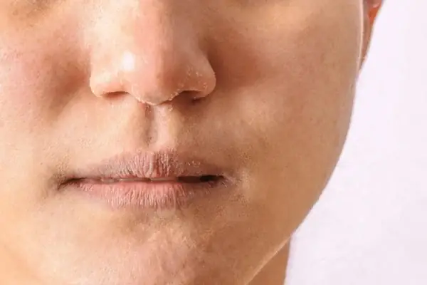 Cách Chữa Nẻ Da Mặt Cho Bé An Toàn Và Hiệu Quả Cách Chữa Nẻ Da Mặt Cho Bé An Toàn Và Hiệu Quả