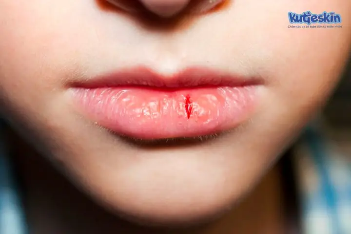 Cách Chữa Nẻ Môi Cho Bé: Nguyên Nhân, Dấu Hiệu Và Giải Pháp An Toàn