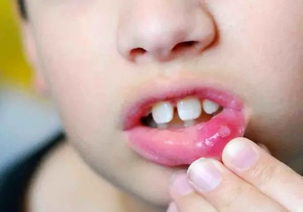 Cách Chữa Rộp Lưỡi Cho Bé An Toàn Và Hiệu Quả Tại Nhà
