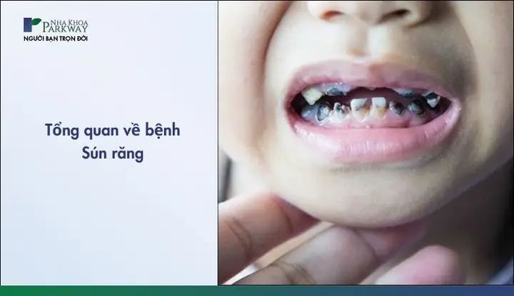 Cách Chữa Sún Răng Sữa Cho Bé An Toàn Và Hiệu Quả Tại Nhà