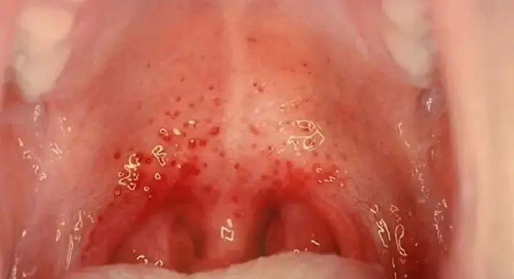 Cách Chữa Viêm Họng Hạt Cho Bé An Toàn, Hiệu Quả Ngay Tại Nhà Cách Chữa Viêm Họng Hạt Cho Bé An Toàn, Hiệu Quả Ngay Tại Nhà