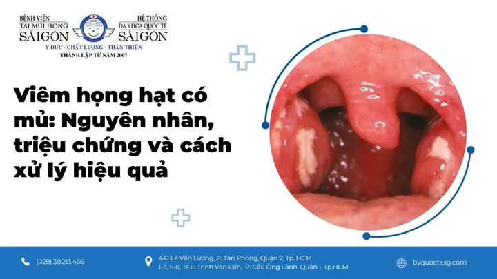 Cách Chữa Viêm Họng Mủ Cho Bé An Toàn, Hiệu Quả Tại Nhà