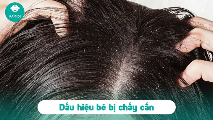 Cách Diệt Chấy Cho Bé An Toàn, Hiệu Quả Tại Nhà Cho Mẹ Cách Diệt Chấy Cho Bé An Toàn, Hiệu Quả Tại Nhà Cho Mẹ