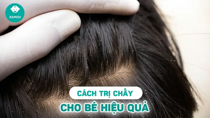 Cách Diệt Chấy Cho Bé An Toàn, Hiệu Quả Tại Nhà Cho Mẹ Cách Diệt Chấy Cho Bé An Toàn, Hiệu Quả Tại Nhà Cho Mẹ