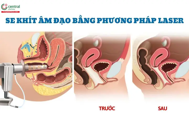 Top 9 Cách Làm Hồng Và Se Khít Vùng Kín Tại Nhà An Toàn, Hiệu Quả