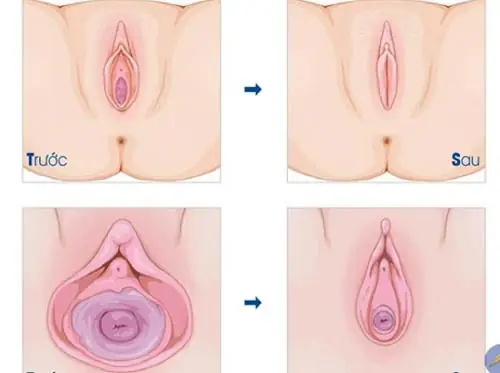 Cách Làm Cô Bé Se Khít: Phương Pháp Hiệu Quả & An Toàn Tại Nhà