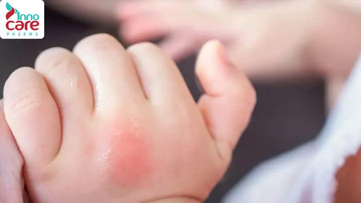 Cách Làm Dịu Vết Muỗi Đốt Cho Bé Nhanh Chóng & An Toàn Tại Nhà
