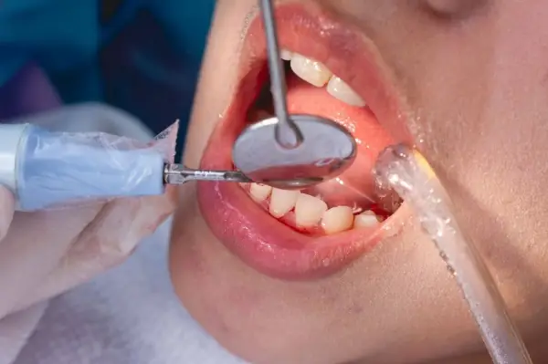 Cách Lấy Cao Răng Cho Bé: Hướng Dẫn Từ A-Z Cho Phụ Huynh