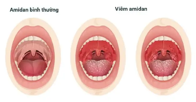 Cách Trị Viêm Amidan Cho Bé Tại Nhà Hiệu Quả Mà Không Cần Dùng Thuốc