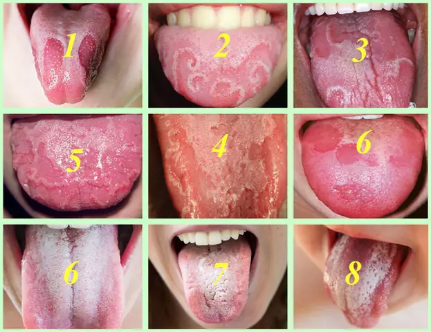 Cách Trị Đẹn Lưỡi Cho Bé An Toàn, Hiệu Quả Tại Nhà