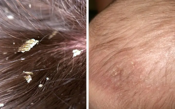 Cách Trị Gàu Cho Bé An Toàn, Hiệu Quả Tại Nhà (nguyên Nhân & Giải Pháp Tự Nhiên) Cách Trị Gàu Cho Bé An Toàn, Hiệu Quả Tại Nhà (nguyên Nhân & Giải Pháp Tự Nhiên)