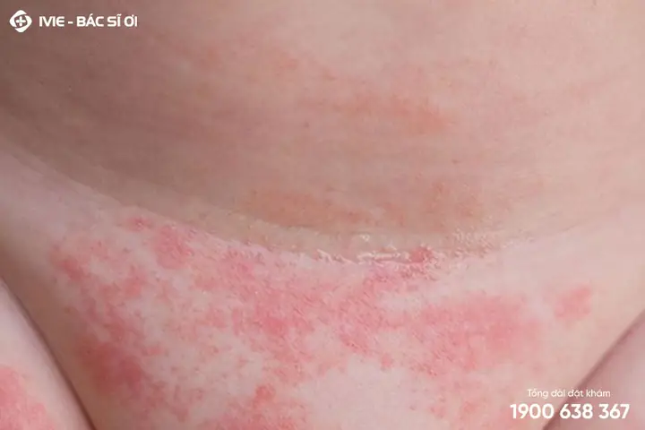 Cách Trị Hăm Vùng Kín Cho Bé An Toàn, Hiệu Quả Tại Nhà Cách Trị Hăm Vùng Kín Cho Bé An Toàn, Hiệu Quả Tại Nhà