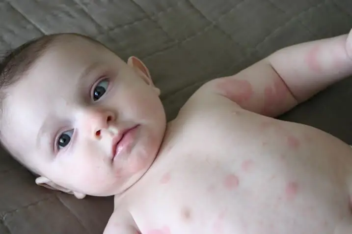 Cách Trị Nổi Mề Đay Cho Bé: Hướng Dẫn Chi Tiết Tại Nhà & Lưu Ý An Toàn