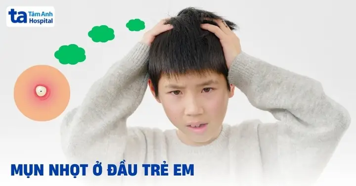 Cách Trị Mụn Nhọt Ở Đầu Cho Bé: Nguyên Nhân, Dấu Hiệu Và Giải Pháp An Toàn Cách Trị Mụn Nhọt Ở Đầu Cho Bé: Nguyên Nhân, Dấu Hiệu Và Giải Pháp An Toàn