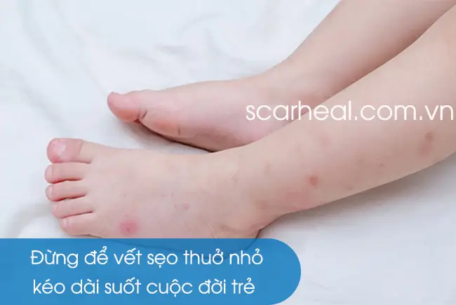 10+ Cách Trị Sẹo Thâm Cho Bé An Toàn & Hiệu Quả Tại Nhà 10+ Cách Trị Sẹo Thâm Cho Bé An Toàn & Hiệu Quả Tại Nhà