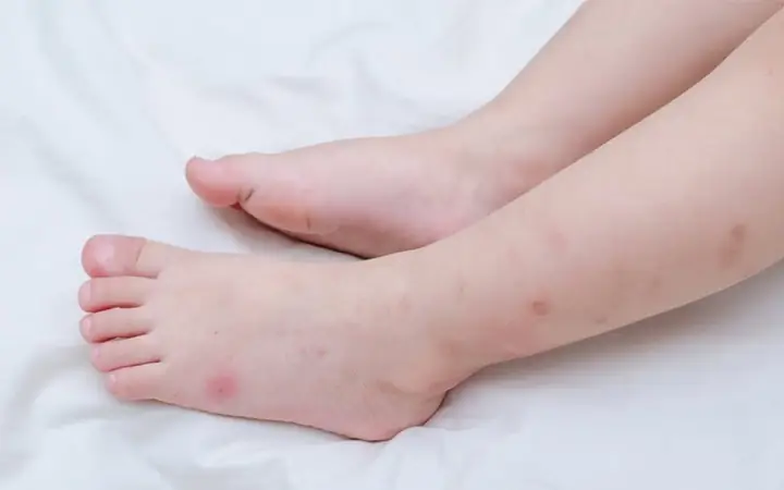 10+ Cách Trị Sẹo Thâm Cho Bé An Toàn & Hiệu Quả Tại Nhà 10+ Cách Trị Sẹo Thâm Cho Bé An Toàn & Hiệu Quả Tại Nhà