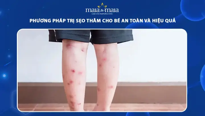 10+ Cách Trị Sẹo Thâm Cho Bé An Toàn & Hiệu Quả Tại Nhà 10+ Cách Trị Sẹo Thâm Cho Bé An Toàn & Hiệu Quả Tại Nhà
