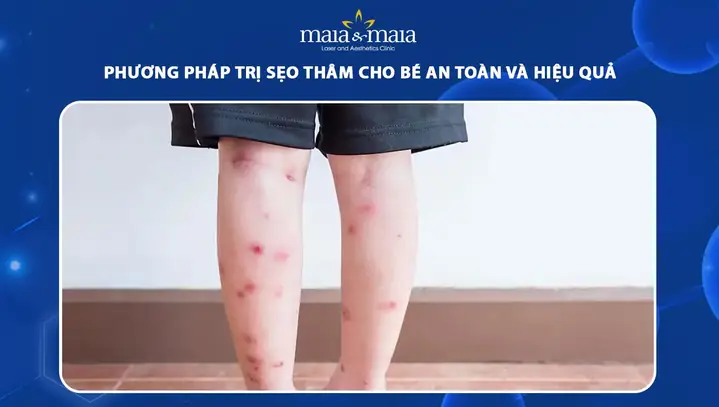 10+ Cách Trị Sẹo Thâm Cho Bé An Toàn & Hiệu Quả Tại Nhà 10+ Cách Trị Sẹo Thâm Cho Bé An Toàn & Hiệu Quả Tại Nhà