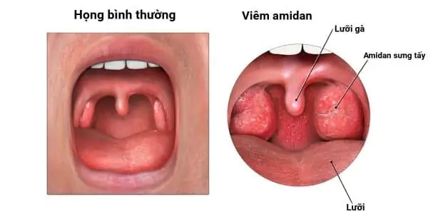 Địa Chỉ Cắt Amidan Cho Bé An Toàn, Hiệu Quả Ở Đâu Tốt Nhất?