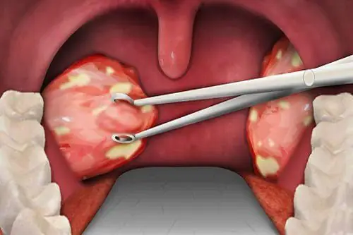 Địa Chỉ Cắt Amidan Cho Bé An Toàn, Hiệu Quả Ở Đâu Tốt Nhất?