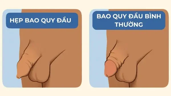 Cắt Bao Quy Đầu Cho Bé Ở Đâu TPHCM: Địa Chỉ Uy Tín, Chi Phí & Lưu Ý Quan Trọng