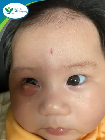 Chích Lẹo Mắt Cho Bé Ở Đâu Uy Tín, An Toàn Và Chi Phí Bao Nhiêu?