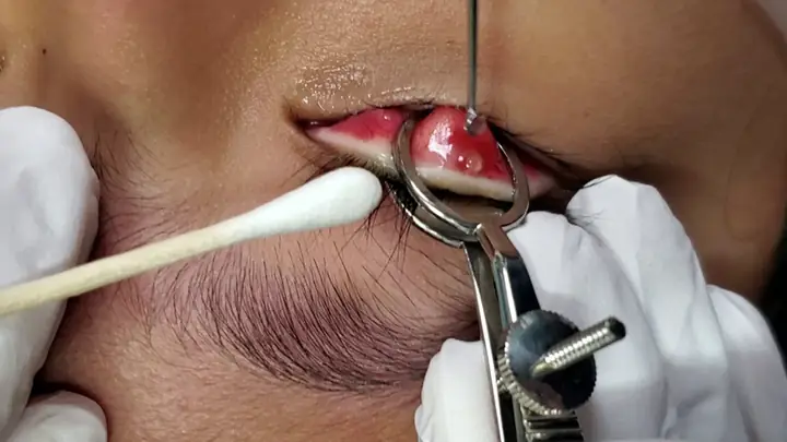 Chích Lẹo Mắt Cho Bé Ở Đâu Uy Tín, An Toàn Và Chi Phí Bao Nhiêu?
