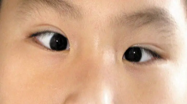 Chỉnh Mắt Lé Cho Bé: Nguyên Nhân, Dấu Hiệu Và Phương Pháp Điều Trị Hiệu Quả Chỉnh Mắt Lé Cho Bé: Nguyên Nhân, Dấu Hiệu Và Phương Pháp Điều Trị Hiệu Quả