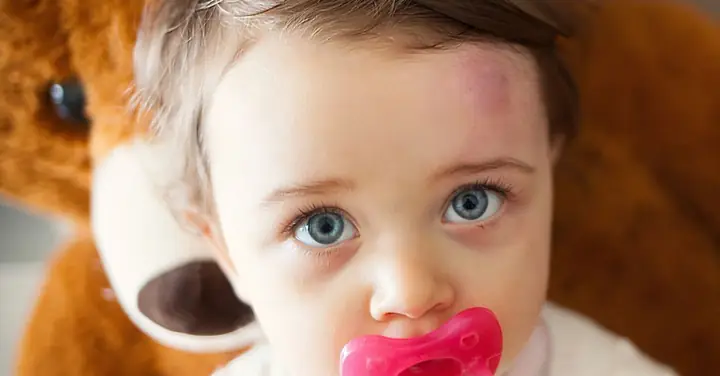 Cách Xử Lý Vết Bầm Tím Cho Bé An Toàn Và Nhanh Chóng Tại Nhà