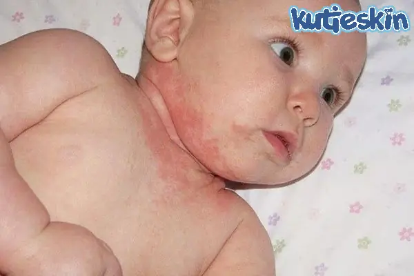 Chữa Hăm Cổ Cho Bé: Dấu Hiệu, Nguyên Nhân Và Cách Khắc Phục Hiệu Quả