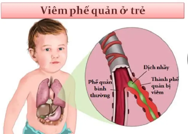 Chữa Hen Phế Quản Cho Bé: Hướng Dẫn Toàn Diện Từ A-z