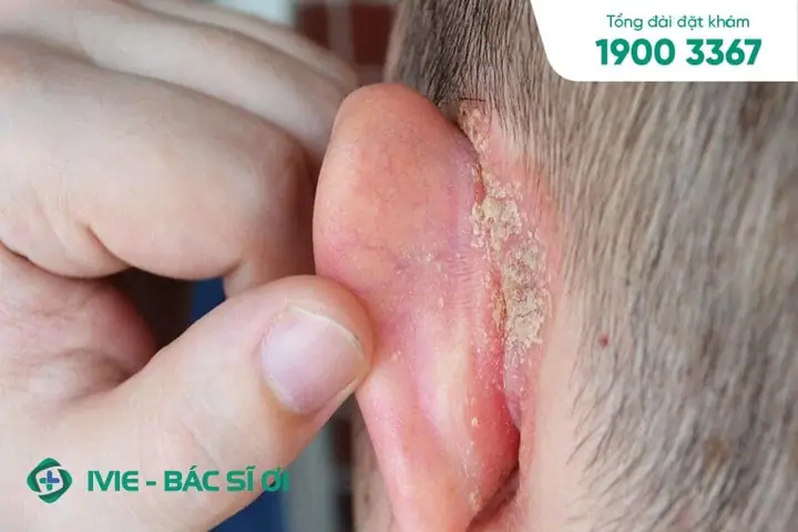 Bé Bị Nứt Kẽ Tai: Nguyên Nhân, Dấu Hiệu Và Cách Xử Lý Hiệu Quả