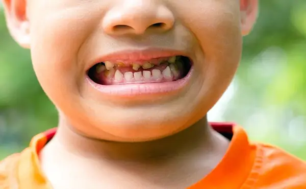 18 Cách Chữa Sâu Răng Cho Bé Tại Nhà Và Đến Nha Khoa Hiệu Quả