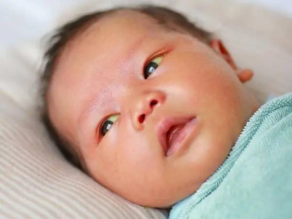 Chữa Vàng Da Cho Bé: Nguyên Nhân, Dấu Hiệu Và Các Phương Pháp Dân Gian Hiệu Quả