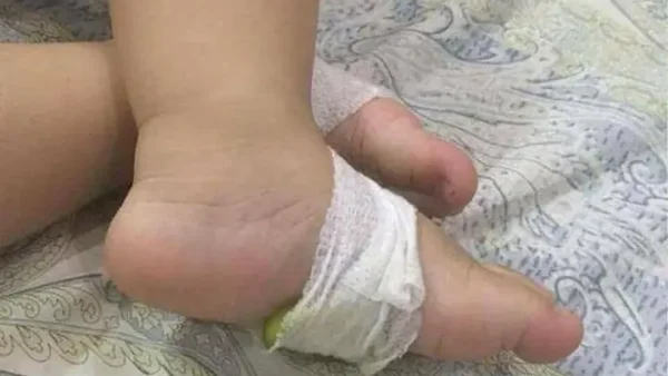 Hạ Sốt Cho Bé Bằng Chanh Tươi: Hướng Dẫn Chi Tiết Và Những Lưu Ý An Toàn