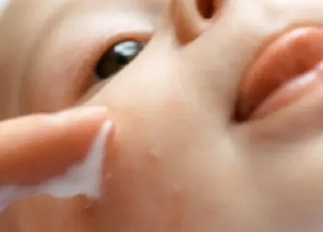 10 Cách Làm Dịu Vết Muỗi Đốt Cho Bé Nhanh Chóng Tại Nhà