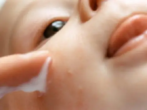 10 Cách Làm Dịu Vết Muỗi Đốt Cho Bé Nhanh Chóng Tại Nhà 10 Cách Làm Dịu Vết Muỗi Đốt Cho Bé Nhanh Chóng Tại Nhà