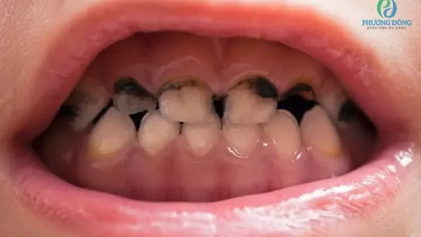 6 Cách Tẩy Mảng Bám Đen Trên Răng Bé An Toàn & Hiệu Quả Tại Nhà