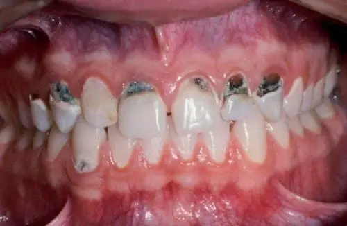 Cách Tẩy Mảng Bám Đen Trên Răng Bé An Toàn & Hiệu Quả Tại Nhà Cách Tẩy Mảng Bám Đen Trên Răng Bé An Toàn & Hiệu Quả Tại Nhà