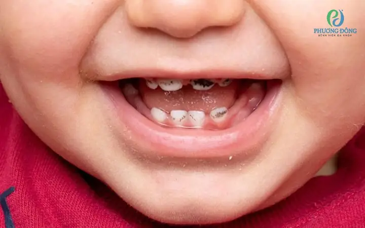 Cách Tẩy Mảng Bám Đen Trên Răng Bé An Toàn & Hiệu Quả Tại Nhà Cách Tẩy Mảng Bám Đen Trên Răng Bé An Toàn & Hiệu Quả Tại Nhà